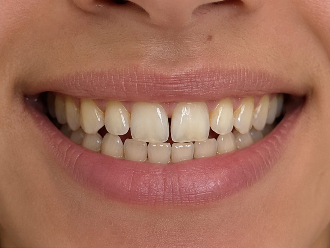 Sonrisa antes del tratamiento de estética dental (imagen ilustrativa)