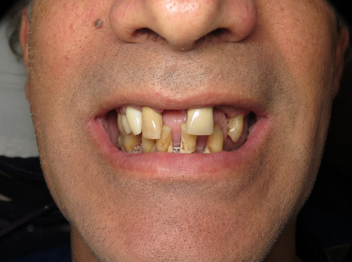 Boca antes de la colocación de implante dental (imagen ilustrativa)