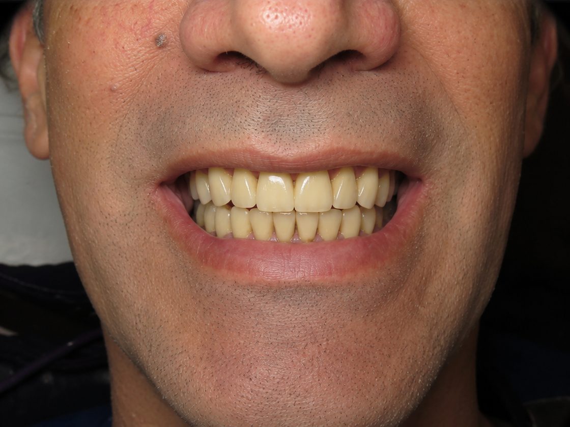 Sonrisa completa después del implante dental (imagen ilustrativa)